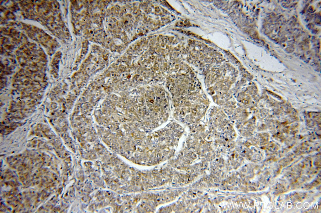 Immunohistochemistry (IHC) staining of human liver cancer tissue using HAUS3 Polyclonal antibody (18991-1-AP)