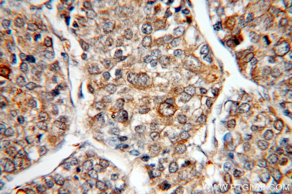 IHC staining of human liver cancer using 18991-1-AP