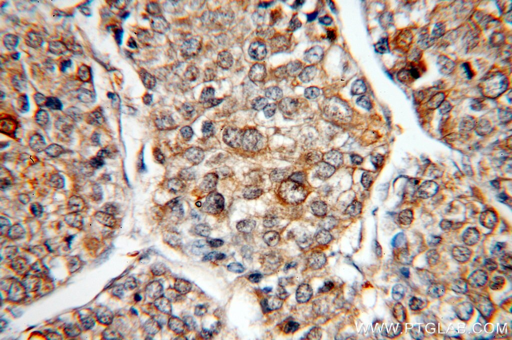 Immunohistochemistry (IHC) staining of human liver cancer tissue using HAUS3 Polyclonal antibody (18991-1-AP)