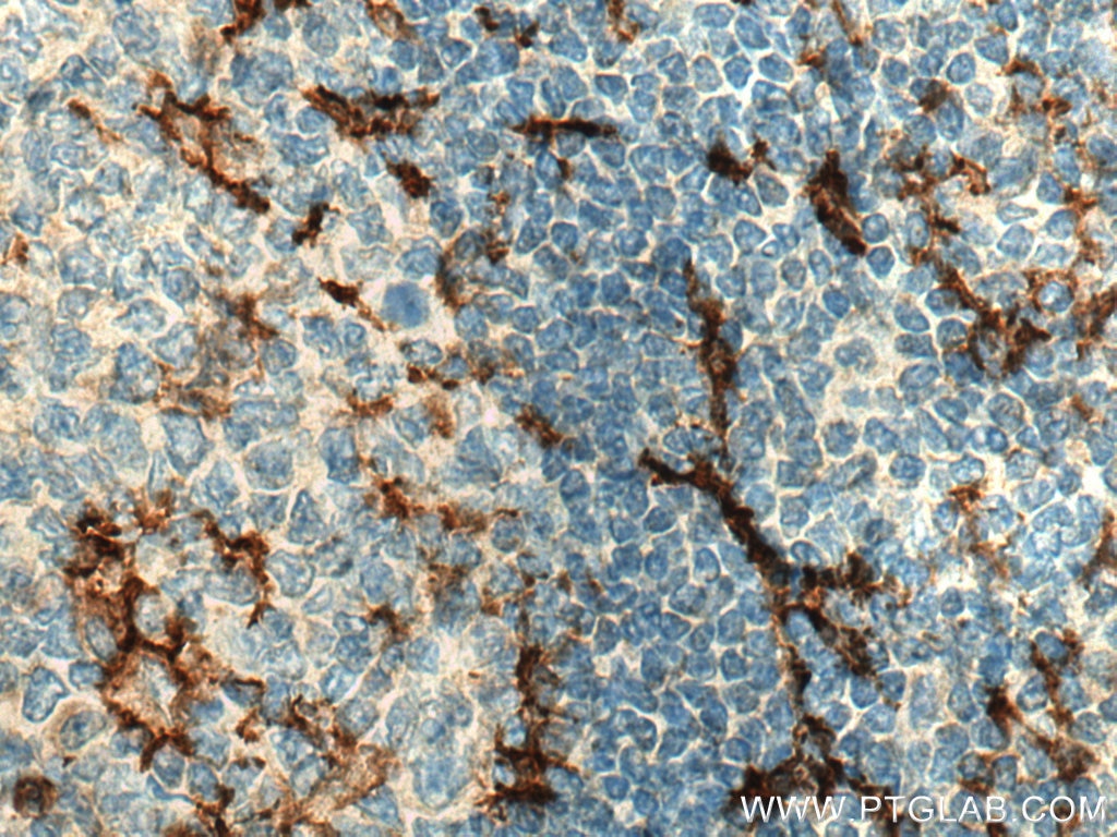 Immunohistochemistry (IHC) staining of human tonsillitis tissue using C5aR Polyclonal antibody (21316-1-AP)