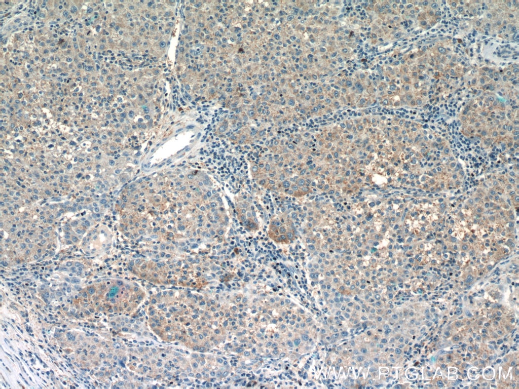 Immunohistochemistry (IHC) staining of human liver cancer tissue using C5orf26 Polyclonal antibody (24698-1-AP)