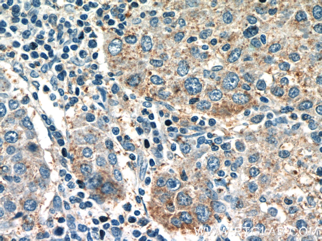 Immunohistochemistry (IHC) staining of human liver cancer tissue using C5orf26 Polyclonal antibody (24698-1-AP)