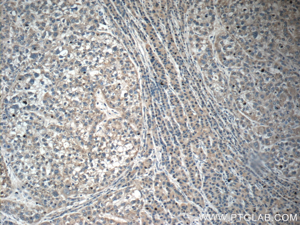 Immunohistochemistry (IHC) staining of human liver cancer tissue using C6 Polyclonal antibody (17239-1-AP)