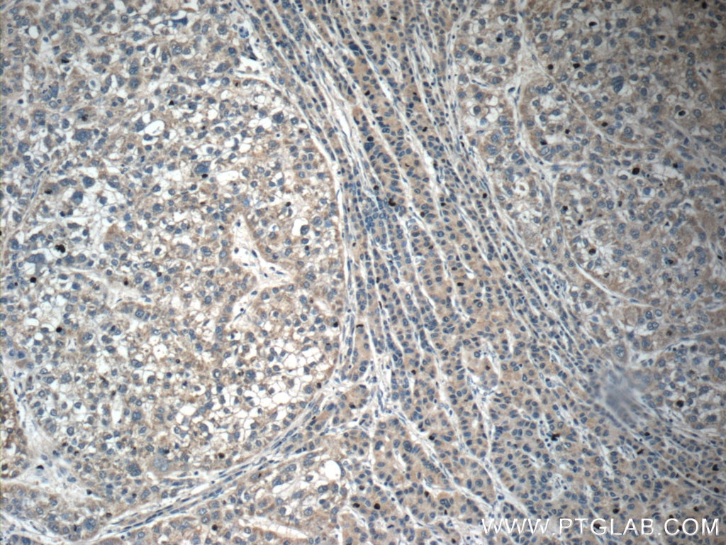 IHC staining of human liver cancer using 17239-1-AP