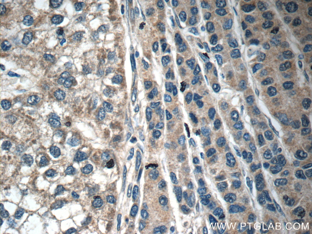IHC staining of human liver cancer using 17239-1-AP