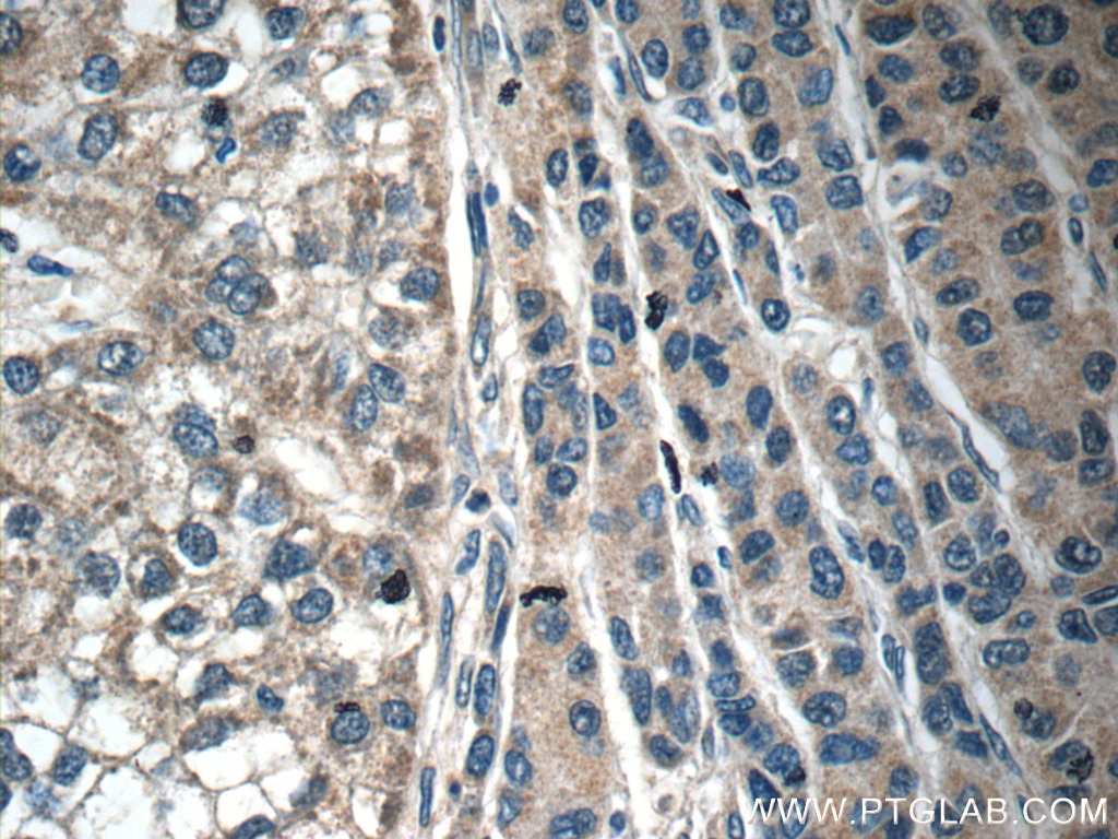 Immunohistochemistry (IHC) staining of human liver cancer tissue using C6 Polyclonal antibody (17239-1-AP)