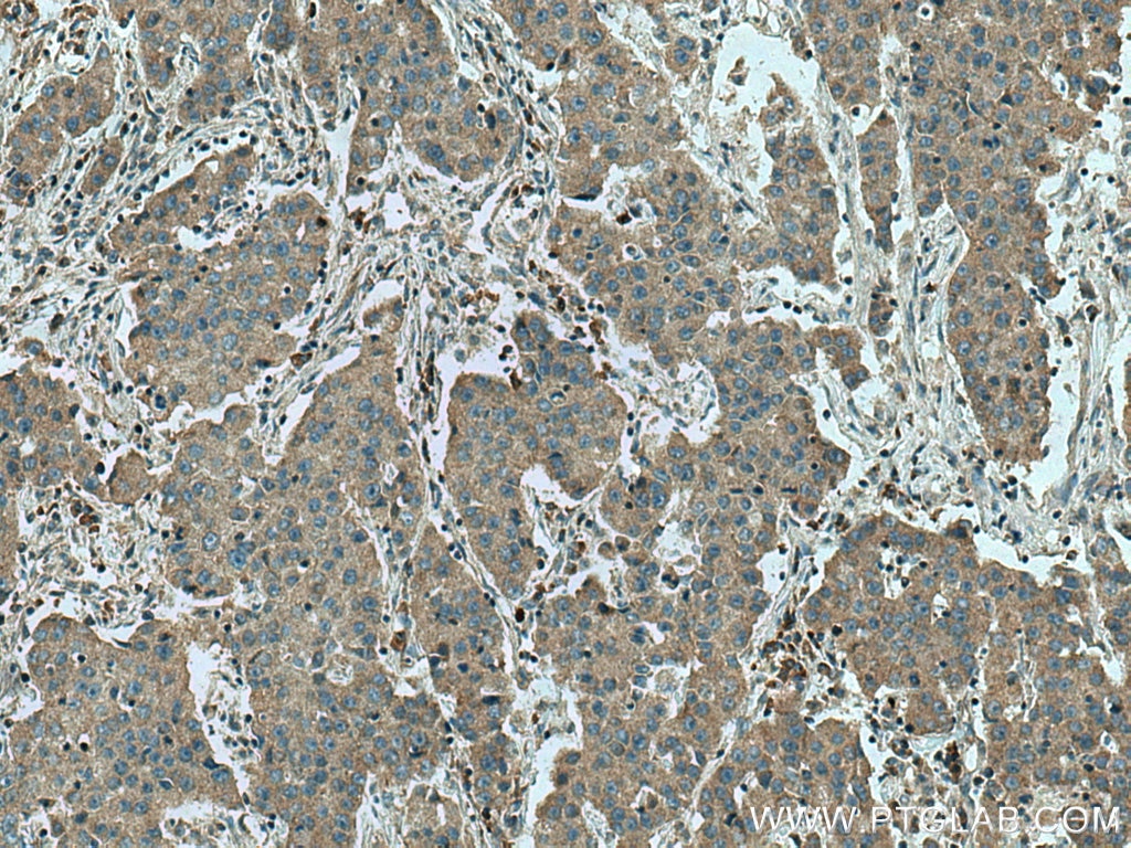 Immunohistochemistry (IHC) staining of human breast cancer tissue using C6orf141 Polyclonal antibody (24355-1-AP)