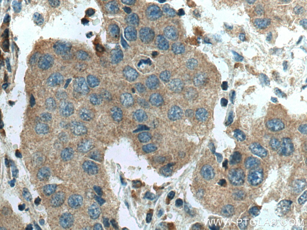 Immunohistochemistry (IHC) staining of human breast cancer tissue using C6orf141 Polyclonal antibody (24355-1-AP)