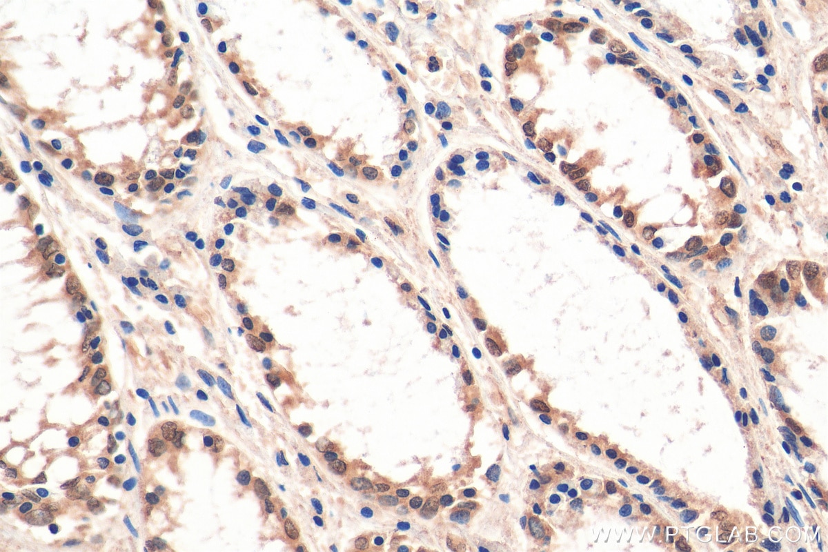 IHC staining of human colon cancer using 26416-1-AP