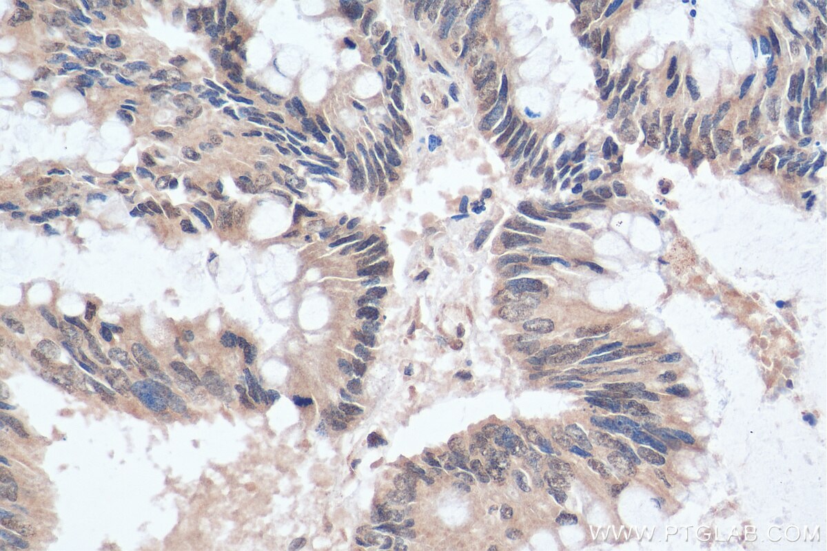 IHC staining of human colon cancer using 26416-1-AP