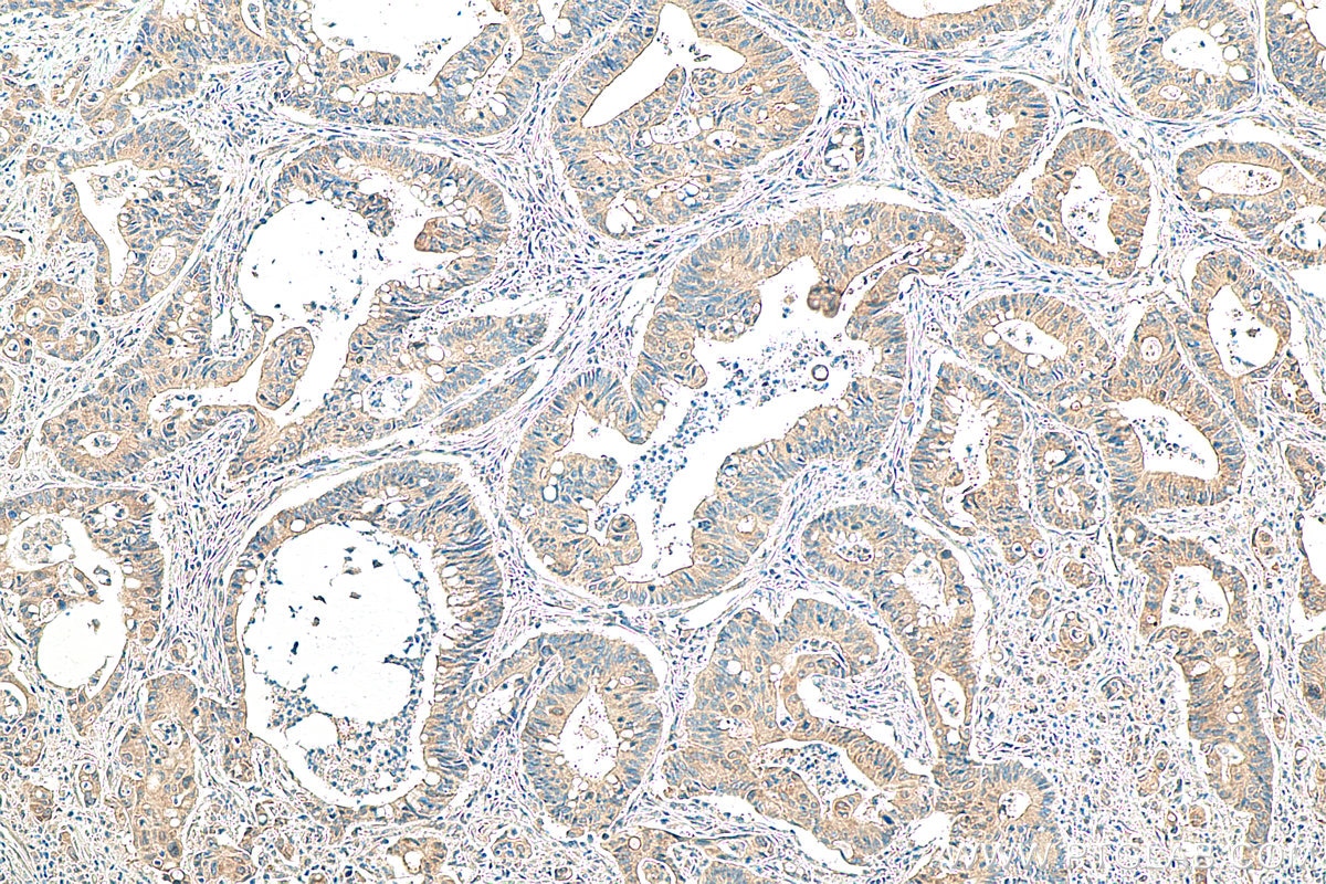 IHC staining of human colon cancer using 26416-1-AP