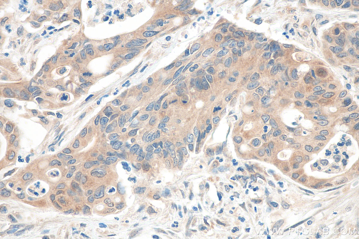 Immunohistochemistry (IHC) staining of human colon cancer tissue using cGAS Polyclonal antibody (26416-1-AP)