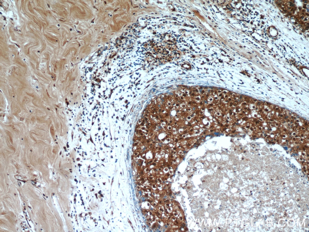 Immunohistochemistry (IHC) staining of human breast cancer tissue using C6orf211/ARMT1 Polyclonal antibody (25124-1-AP)