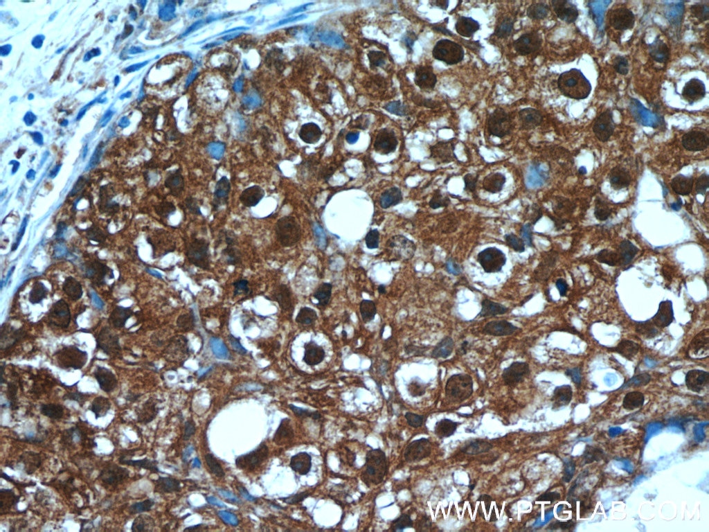 Immunohistochemistry (IHC) staining of human breast cancer tissue using C6orf211/ARMT1 Polyclonal antibody (25124-1-AP)