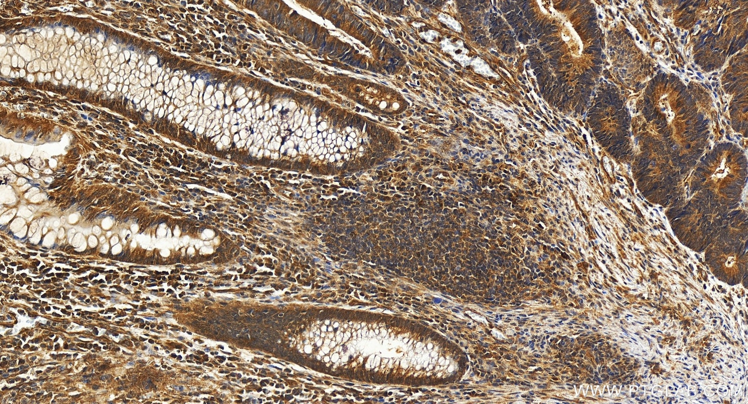 Immunohistochemistry (IHC) staining of human colon cancer tissue using KHDC3L Polyclonal antibody (24989-1-AP)