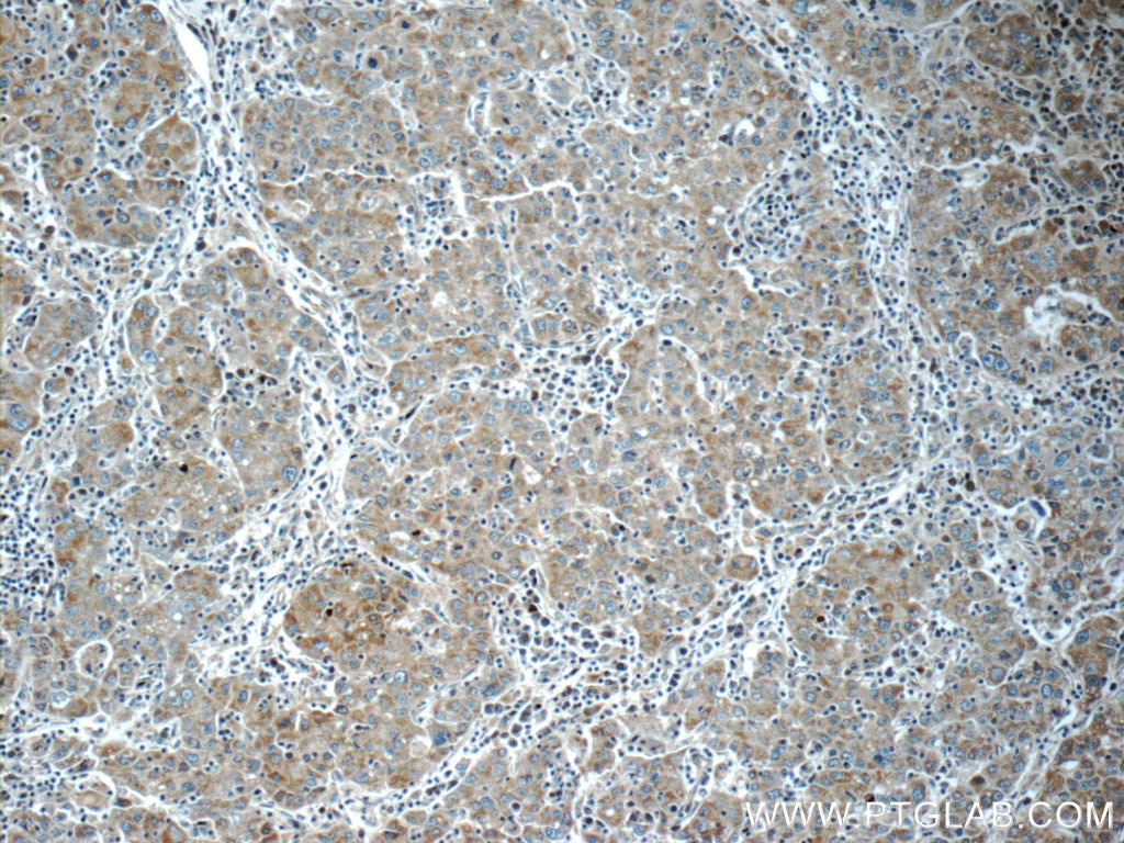 Immunohistochemistry (IHC) staining of human liver cancer tissue using KHDC3L Polyclonal antibody (24989-1-AP)