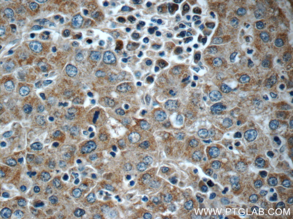 Immunohistochemistry (IHC) staining of human liver cancer tissue using KHDC3L Polyclonal antibody (24989-1-AP)