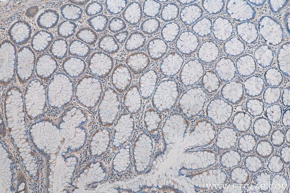Immunohistochemistry (IHC) staining of human colon cancer tissue using C6orf70 Polyclonal antibody (24690-1-AP)