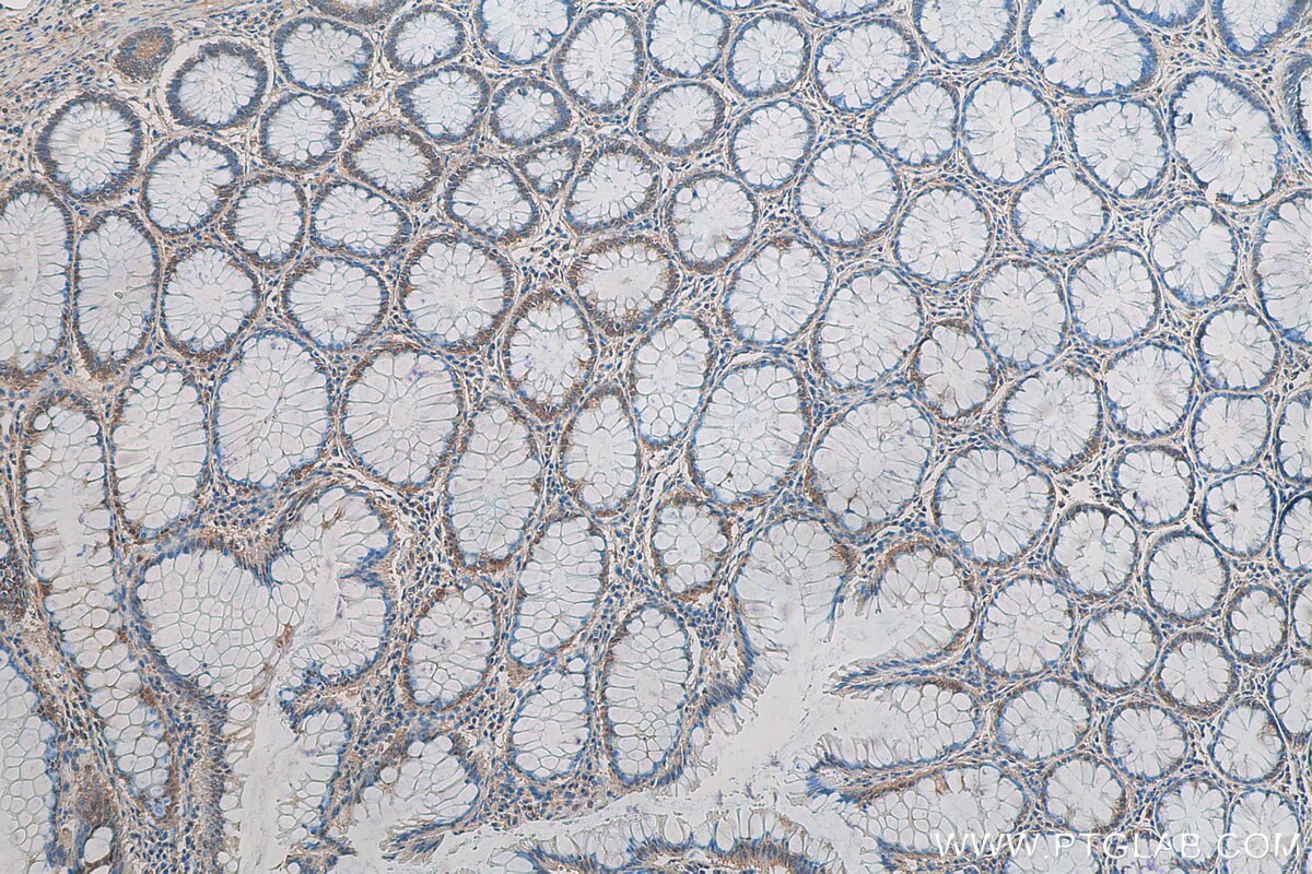 Immunohistochemistry (IHC) staining of human colon cancer tissue using C6orf70 Polyclonal antibody (24690-1-AP)