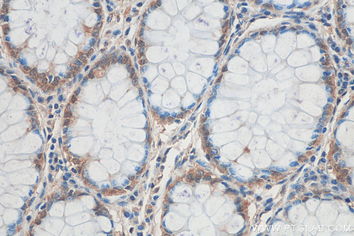 Immunohistochemistry (IHC) staining of human colon cancer tissue using C6orf70 Polyclonal antibody (24690-1-AP)