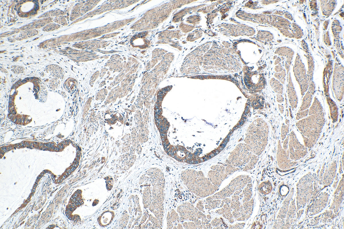 Immunohistochemistry (IHC) staining of human urothelial carcinoma tissue using TMEM243 Polyclonal antibody (20880-1-AP)