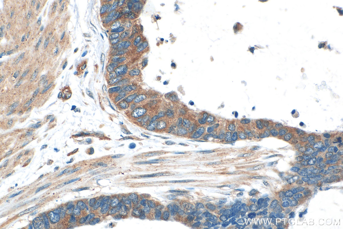 Immunohistochemistry (IHC) staining of human urothelial carcinoma tissue using TMEM243 Polyclonal antibody (20880-1-AP)