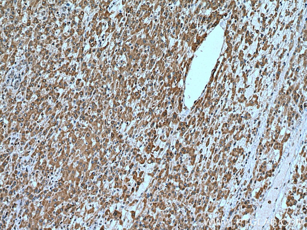 Immunohistochemistry (IHC) staining of human liver cancer tissue using C7orf26 Polyclonal antibody (25529-1-AP)