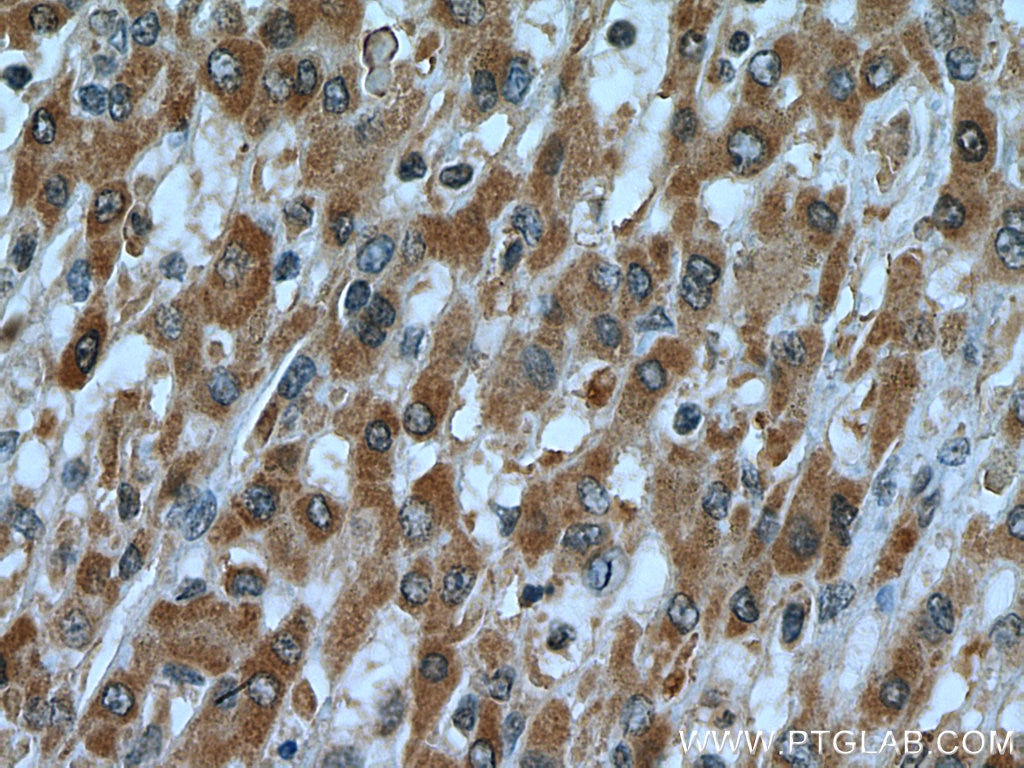 Immunohistochemistry (IHC) staining of human liver cancer tissue using C7orf26 Polyclonal antibody (25529-1-AP)