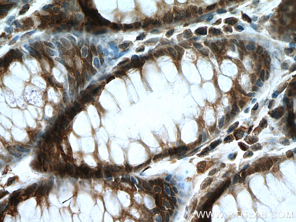 Immunohistochemistry (IHC) staining of human colon cancer tissue using C7orf26 Polyclonal antibody (25529-1-AP)