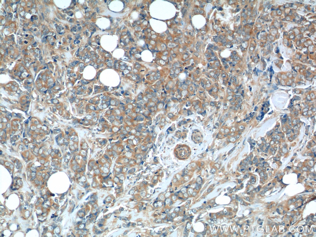 Immunohistochemistry (IHC) staining of human breast cancer tissue using C7orf47 Polyclonal antibody (24214-1-AP)