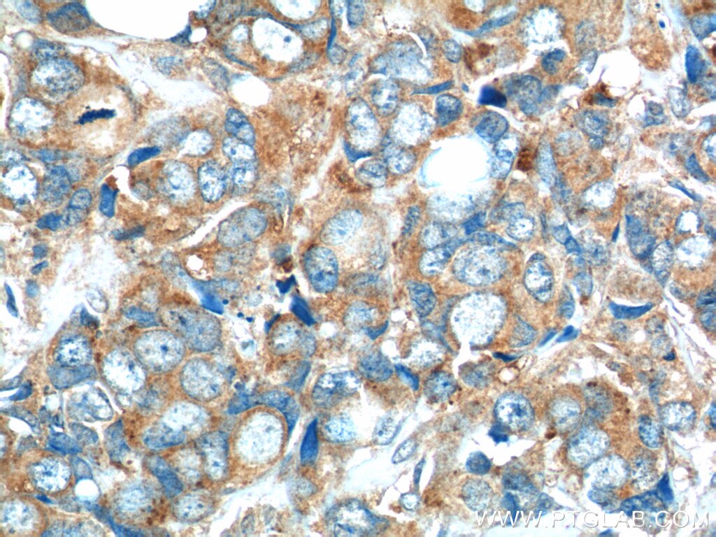 Immunohistochemistry (IHC) staining of human breast cancer tissue using C7orf47 Polyclonal antibody (24214-1-AP)