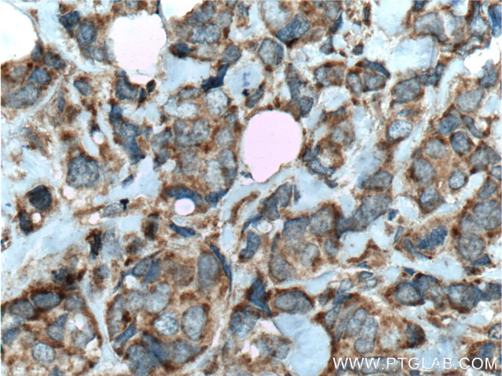 Immunohistochemistry (IHC) staining of human breast cancer tissue using C7orf47 Polyclonal antibody (24214-1-AP)