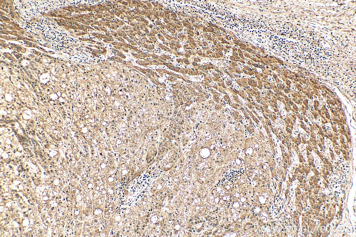 Immunohistochemistry (IHC) staining of human liver cancer tissue using C8G Polyclonal antibody (27200-1-AP)