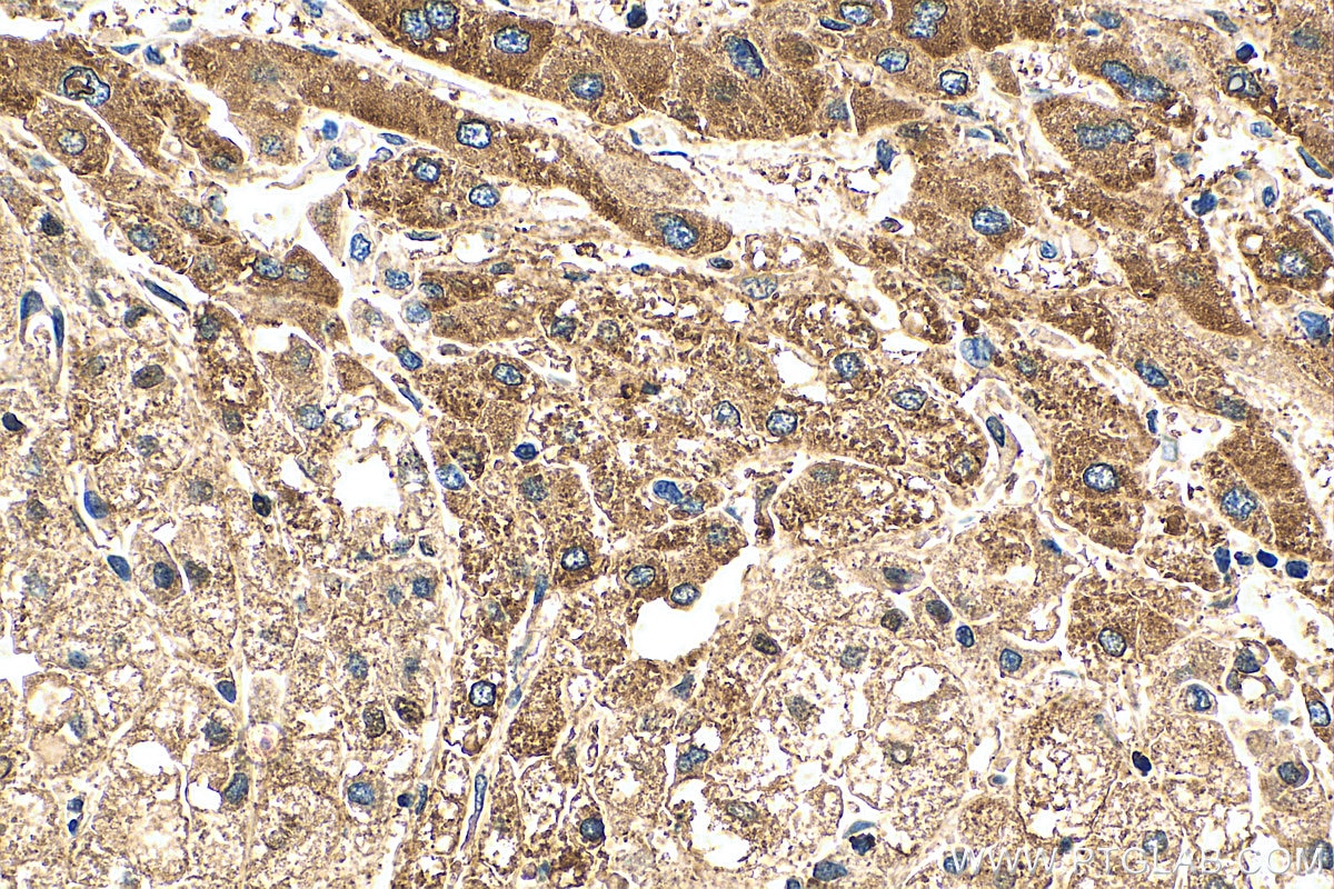 Immunohistochemistry (IHC) staining of human liver cancer tissue using C8G Polyclonal antibody (27200-1-AP)
