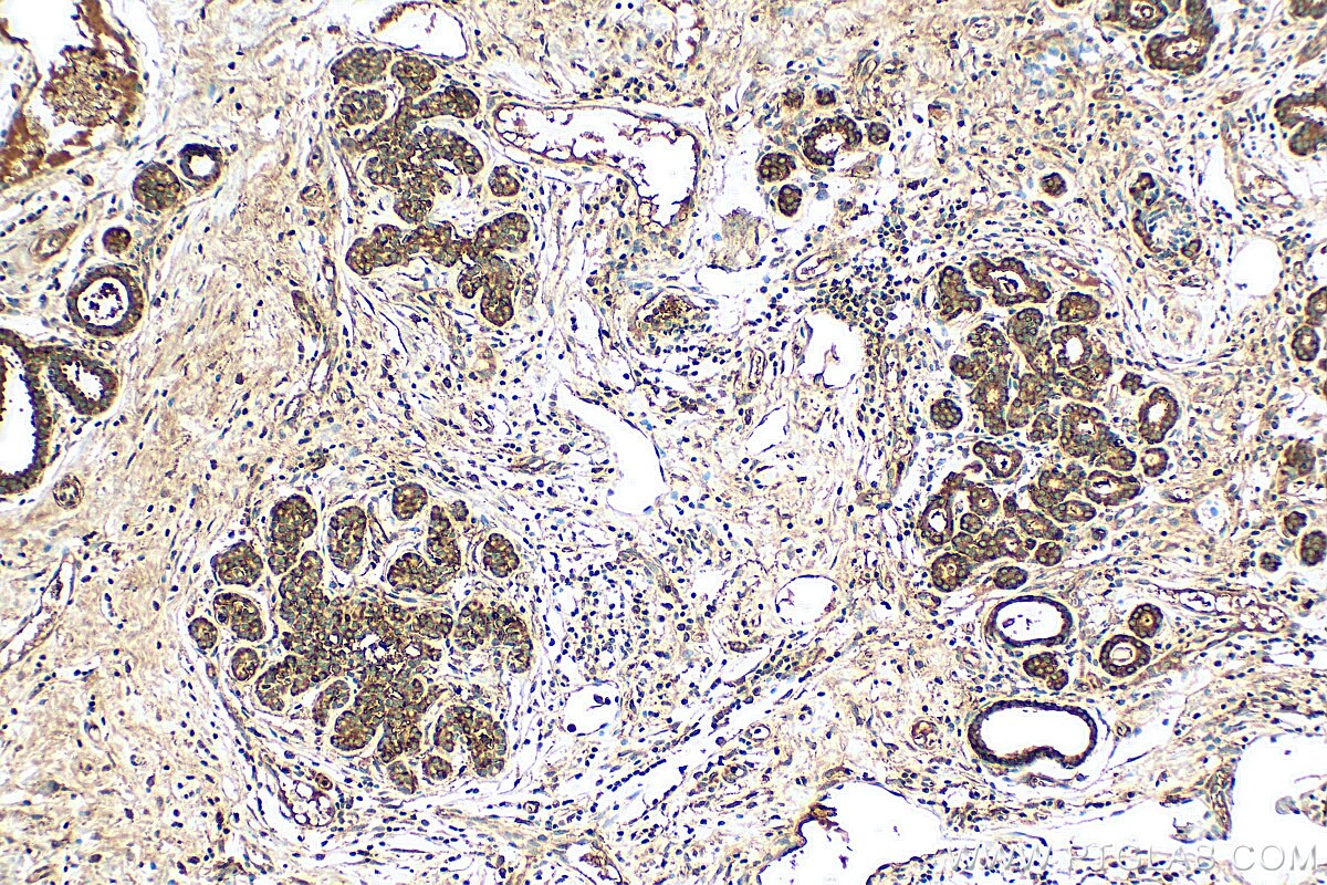 Immunohistochemistry (IHC) staining of human breast cancer tissue using C8G Polyclonal antibody (27200-1-AP)