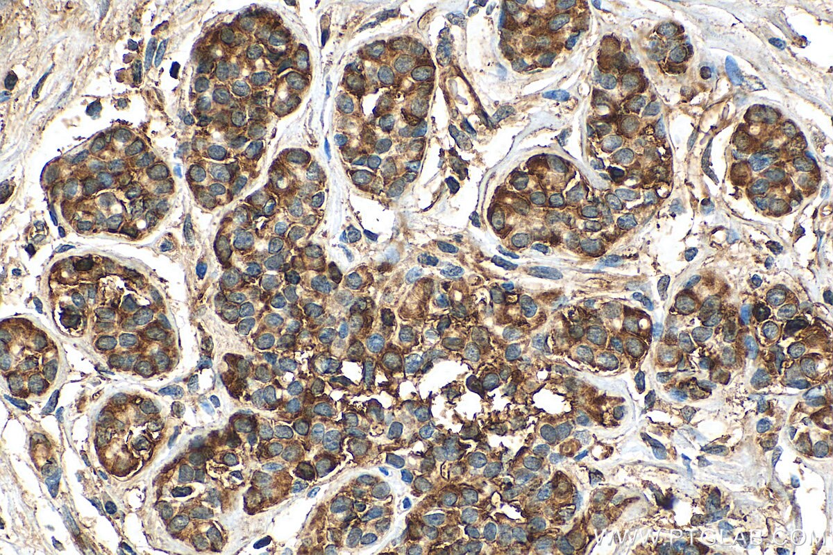 Immunohistochemistry (IHC) staining of human breast cancer tissue using C8G Polyclonal antibody (27200-1-AP)