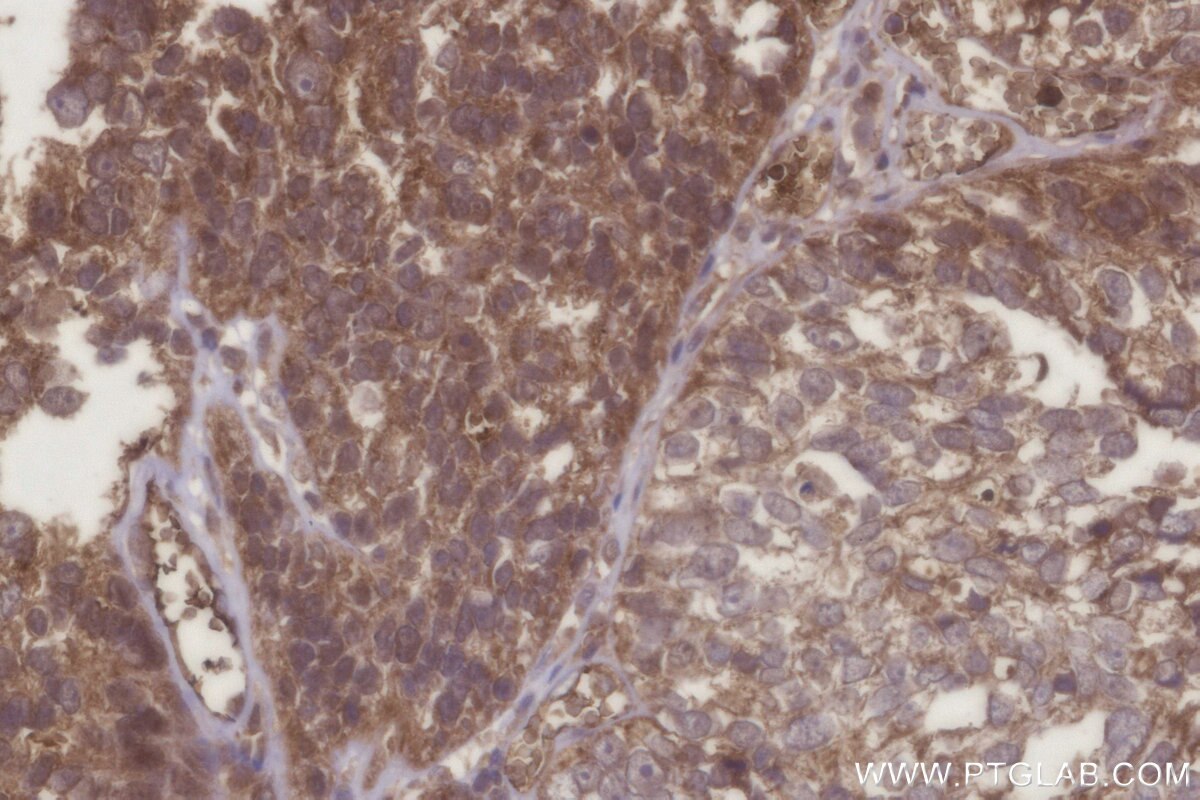 Immunohistochemistry (IHC) staining of human ovary cancer tissue using C8orf4 Polyclonal antibody (26279-1-AP)
