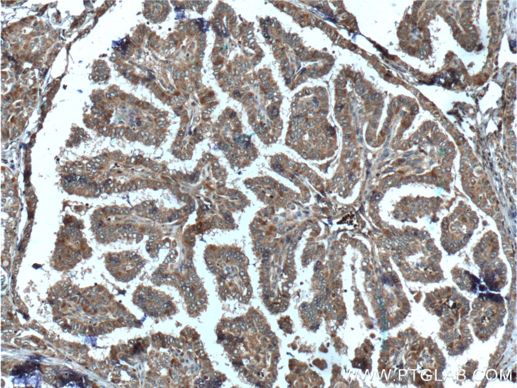 Immunohistochemistry (IHC) staining of human thyroid cancer tissue using C8orf4 Polyclonal antibody (26279-1-AP)