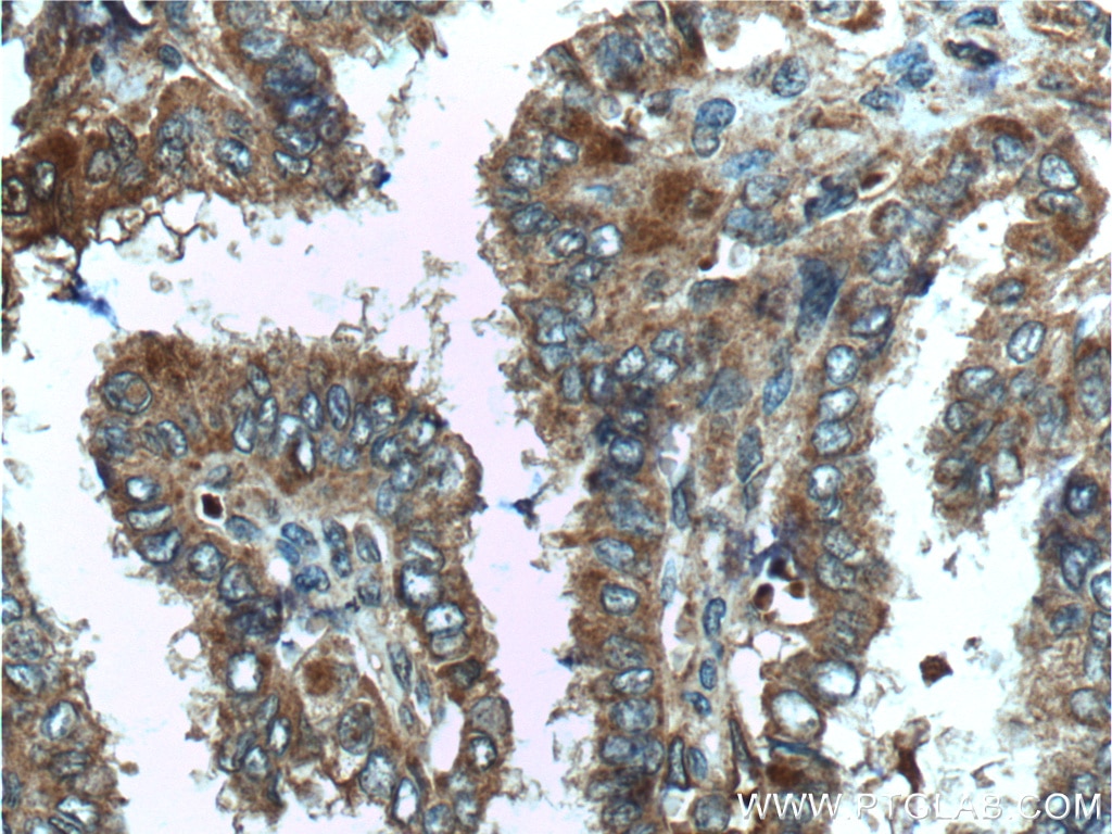 IHC staining of human thyroid cancer using 26279-1-AP