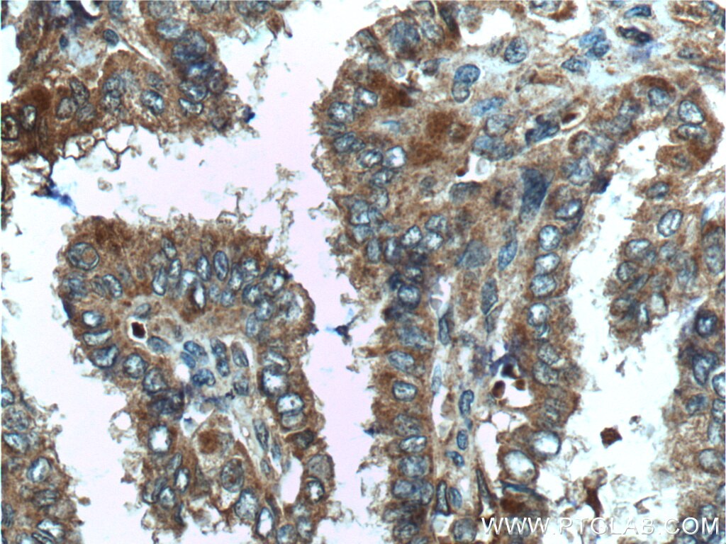 Immunohistochemistry (IHC) staining of human thyroid cancer tissue using C8orf4 Polyclonal antibody (26279-1-AP)