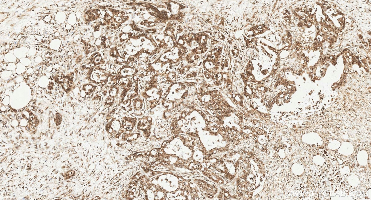 Immunohistochemistry (IHC) staining of human colon cancer tissue using TTI2 Polyclonal antibody (20779-1-AP)