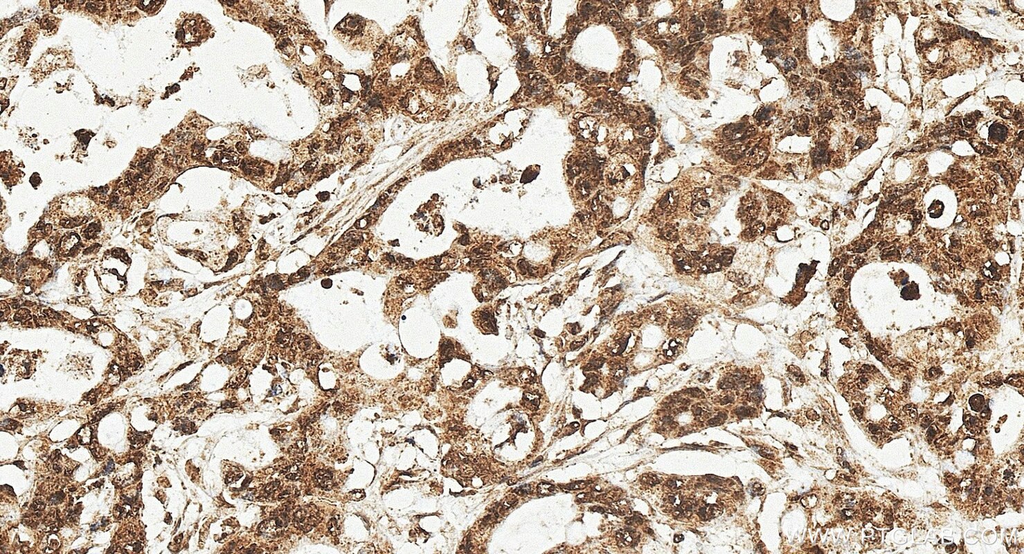 Immunohistochemistry (IHC) staining of human colon cancer tissue using TTI2 Polyclonal antibody (20779-1-AP)