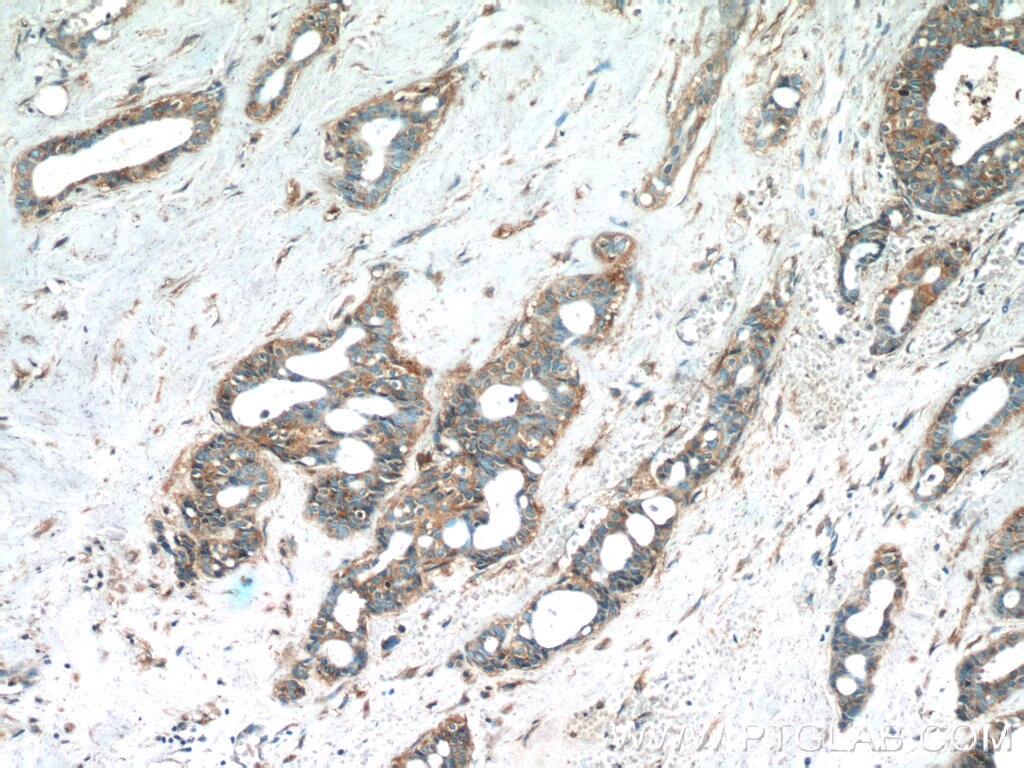 Immunohistochemistry (IHC) staining of human breast cancer tissue using C8orf48 Polyclonal antibody (25020-1-AP)