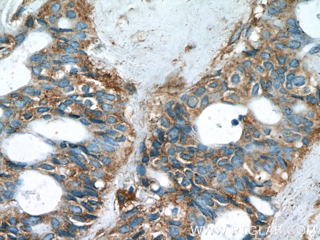 Immunohistochemistry (IHC) staining of human breast cancer tissue using C8orf48 Polyclonal antibody (25020-1-AP)