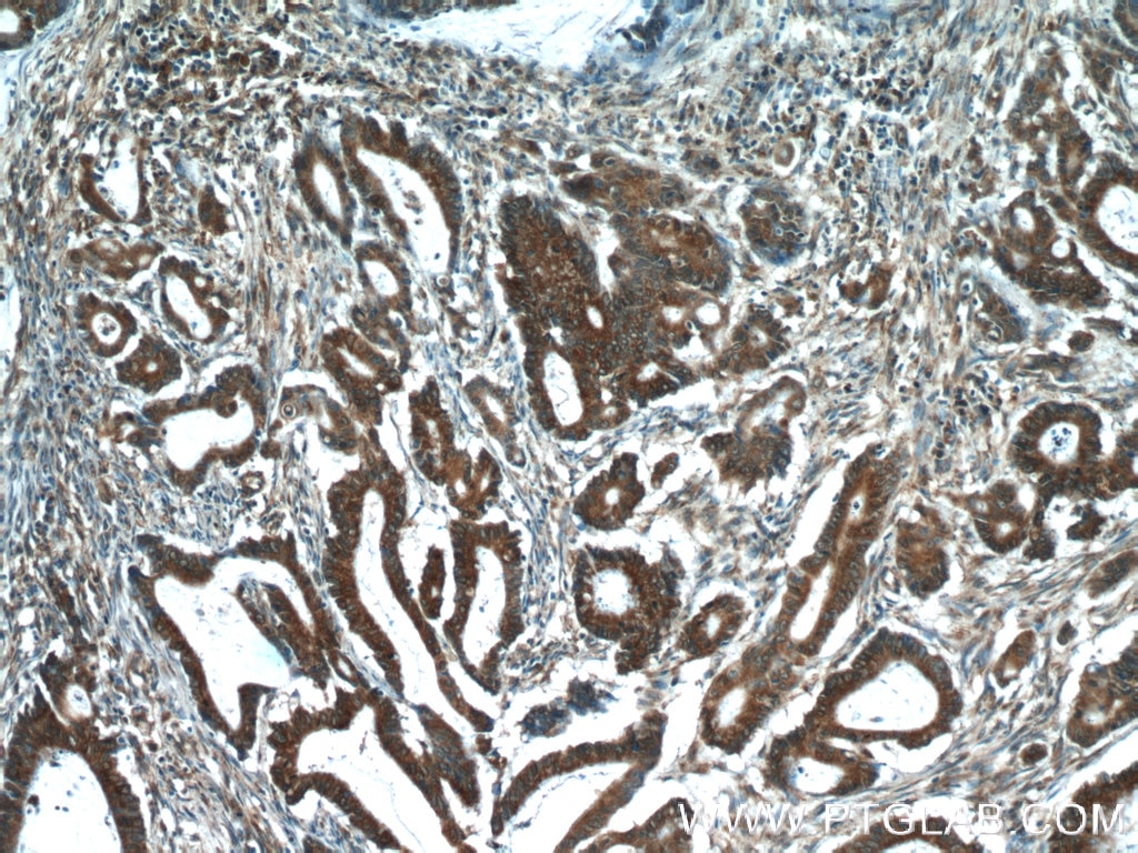 Immunohistochemistry (IHC) staining of human colon cancer tissue using C8orf48 Polyclonal antibody (25020-1-AP)