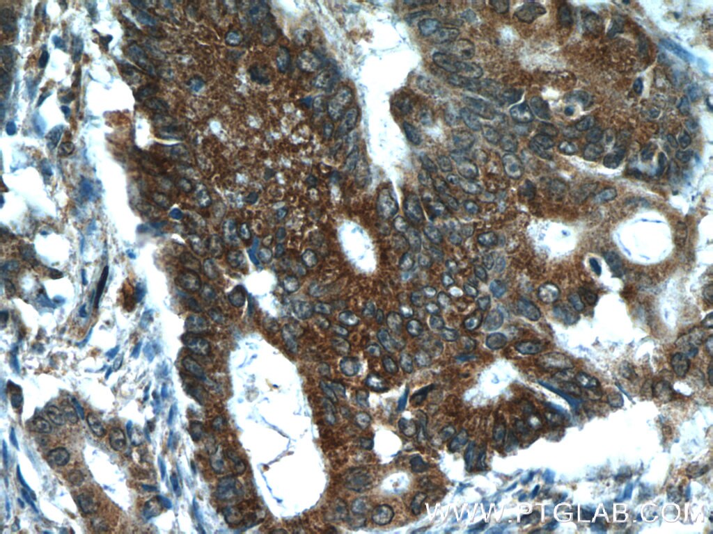 Immunohistochemistry (IHC) staining of human colon cancer tissue using C8orf48 Polyclonal antibody (25020-1-AP)