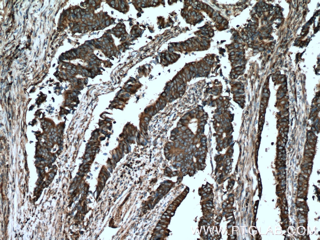 Immunohistochemistry (IHC) staining of human colon cancer tissue using C8orf48 Polyclonal antibody (25020-1-AP)