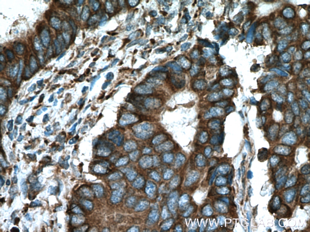 Immunohistochemistry (IHC) staining of human colon cancer tissue using C8orf48 Polyclonal antibody (25020-1-AP)