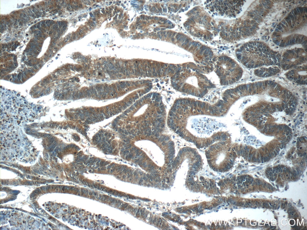 Immunohistochemistry (IHC) staining of human colon cancer tissue using C8orf77 Polyclonal antibody (24549-1-AP)