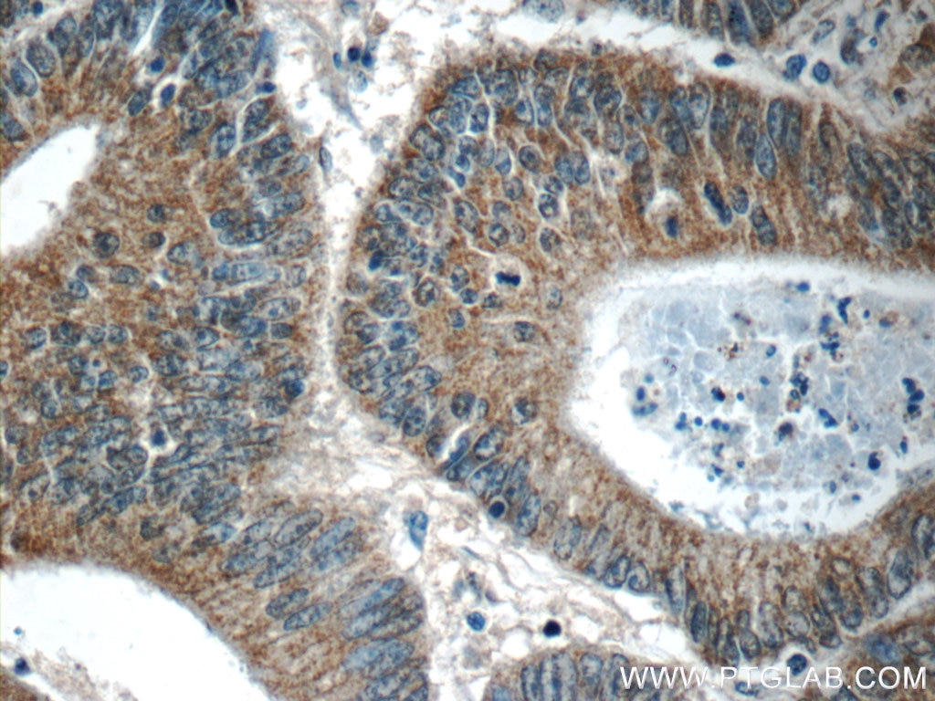 Immunohistochemistry (IHC) staining of human colon cancer tissue using C8orf77 Polyclonal antibody (24549-1-AP)